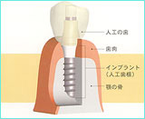 インプラント治療とは