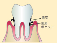 軽度歯周炎