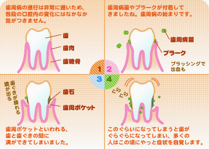 歯周病の原因とは